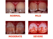Article_thumb_dental_fluorosis_10846_
