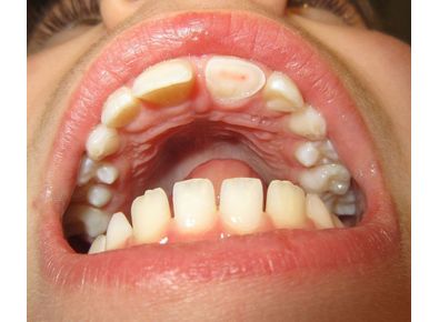 Article_image_1280px-fracturedtooth