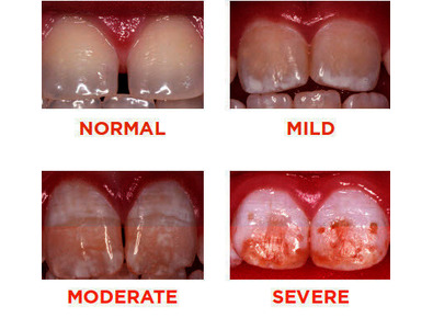 Article_image_dental_fluorosis_10846_