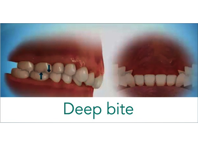 Article_image_l_what-is-deep-bite
