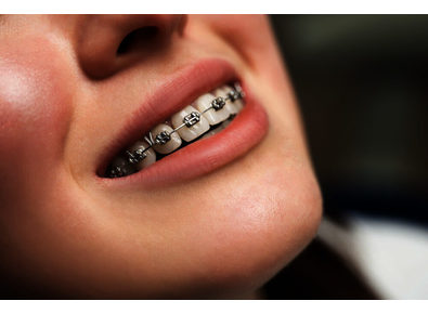 Article_image_types-of-braces_1648491073