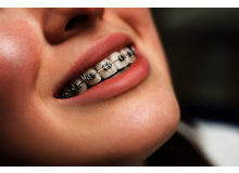 Article_thumb_types-of-braces_1648491073