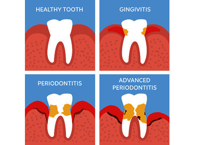 Article_image_thumbnail_periodontal-disease-gettyimages-842463284