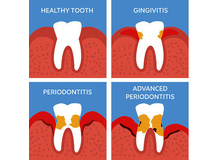 Article_thumb_thumbnail_periodontal-disease-gettyimages-842463284