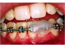 Article_thumb_orthosmile_wax_on_brackets