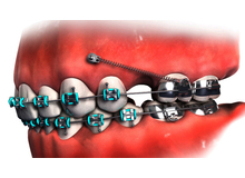 Article_thumb_microemfitevmata