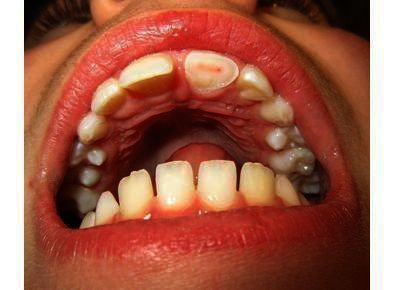 Article_image_article_image_1280px-fracturedtooth