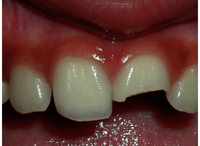 Article_image_broken-tooth