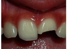 Article_thumb_broken-tooth