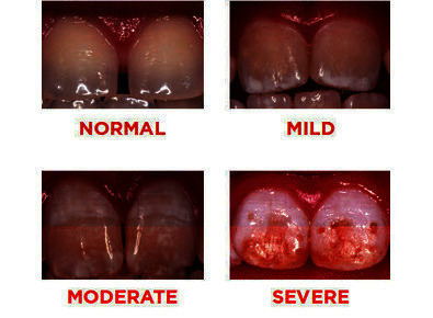 Article_image_article_image_dental_fluorosis_10846_