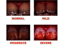 Article_thumb_article_image_dental_fluorosis_10846_